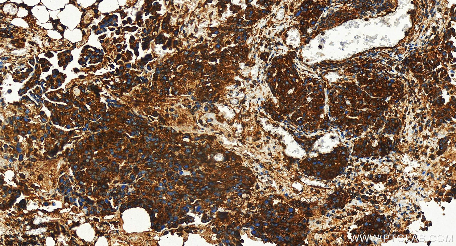 Immunohistochemistry (IHC) staining of human ovary cancer tissue using Cathepsin D Polyclonal antibody (31516-1-AP)