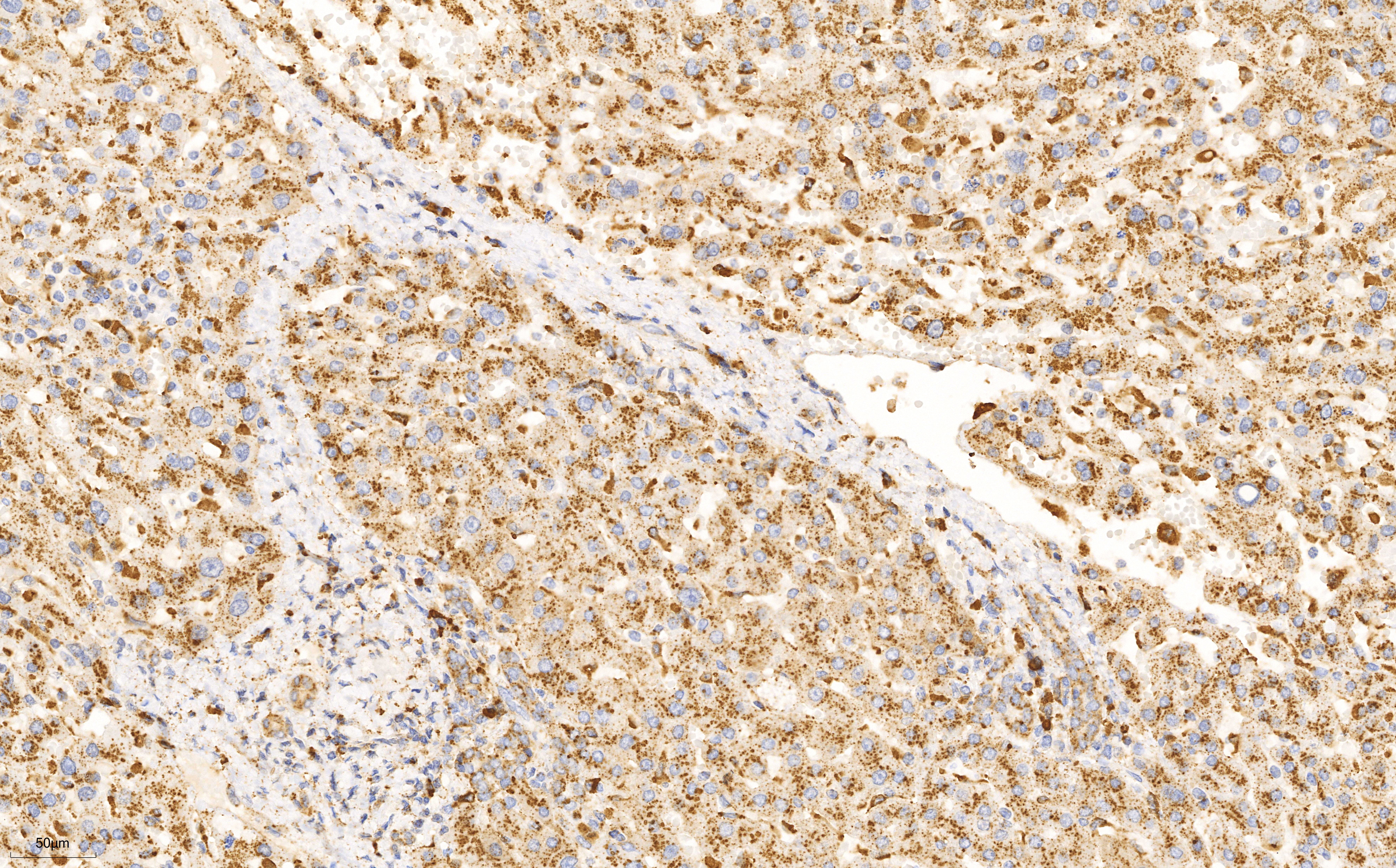 Immunohistochemistry (IHC) staining of human liver cancer tissue using Cathepsin D Monoclonal antibody (66534-1-Ig)