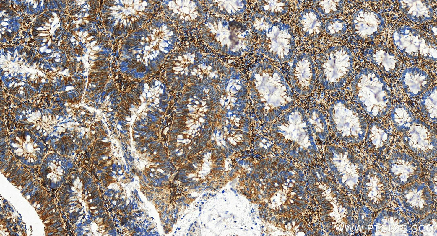 Immunohistochemistry (IHC) staining of human colon cancer tissue using Caveolin-1 Recombinant antibody (84044-1-RR)