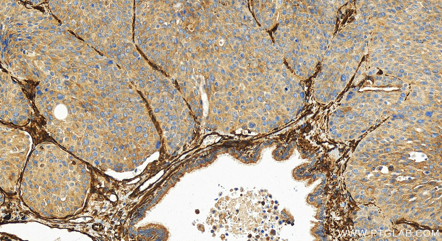 Immunohistochemistry (IHC) staining of human lung squamous cell carcinoma tissue using Caveolin-1 Recombinant antibody (84044-1-RR)