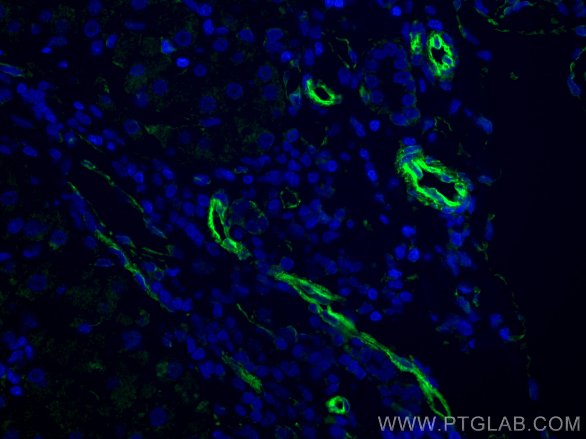 Immunofluorescence (IF) / fluorescent staining of human liver cancer tissue using CoraLite® Plus 488-conjugated Caveolin-1 Monoclona (CL488-66067)