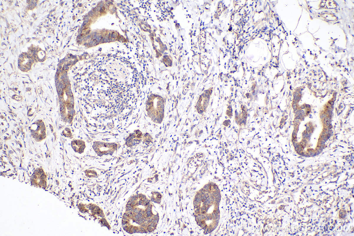 Immunohistochemistry (IHC) staining of human rectal cancer tissue using Ch-TOG Monoclonal antibody (67631-1-Ig)