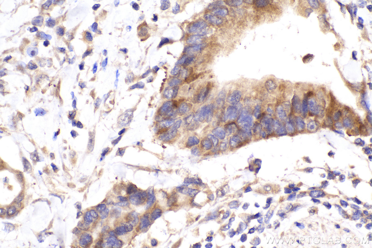 Immunohistochemistry (IHC) staining of human rectal cancer tissue using Ch-TOG Monoclonal antibody (67631-1-Ig)