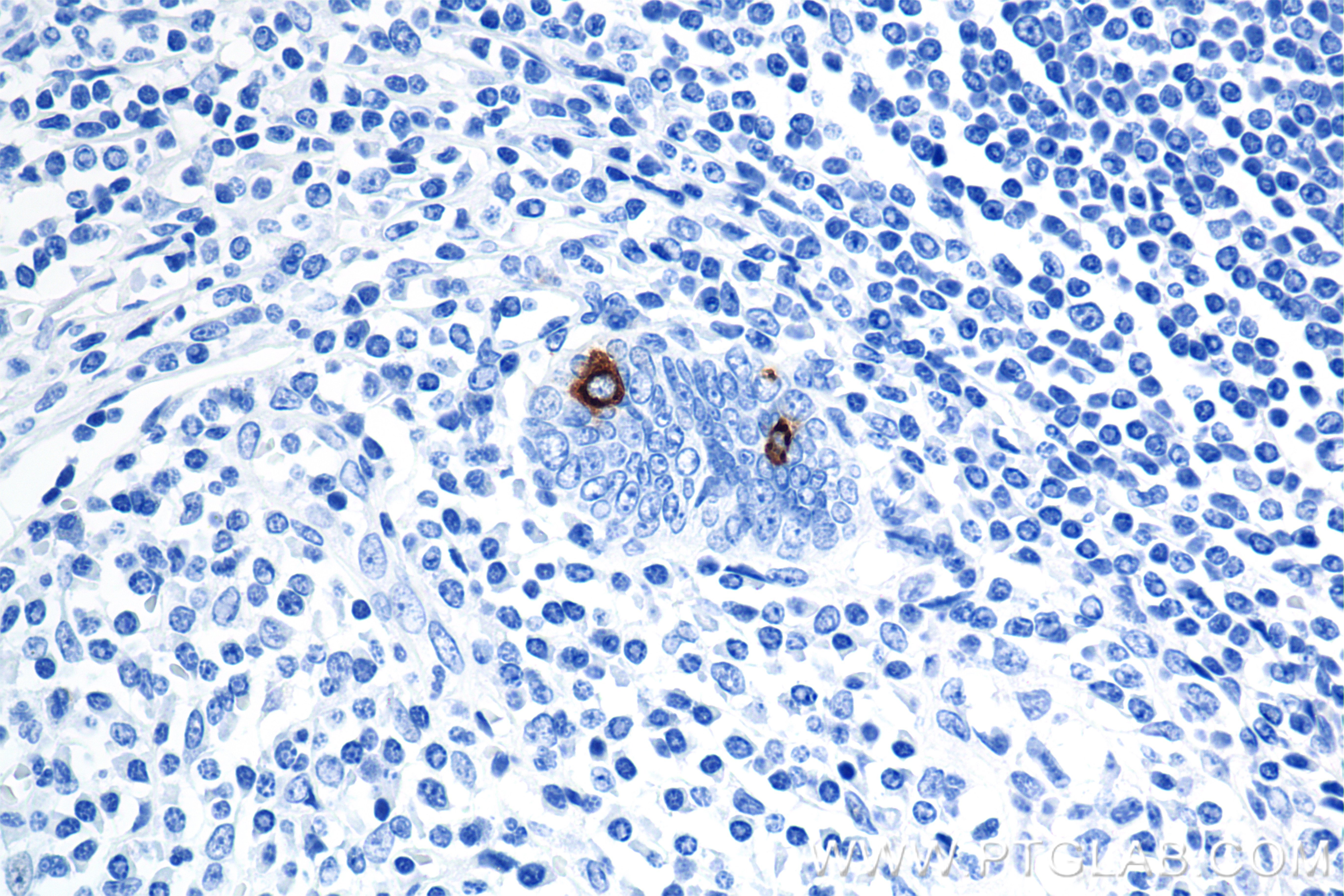 Immunohistochemistry (IHC) staining of human appendix tissue using Chromogranin A Recombinant antibody (85605-2-RR)