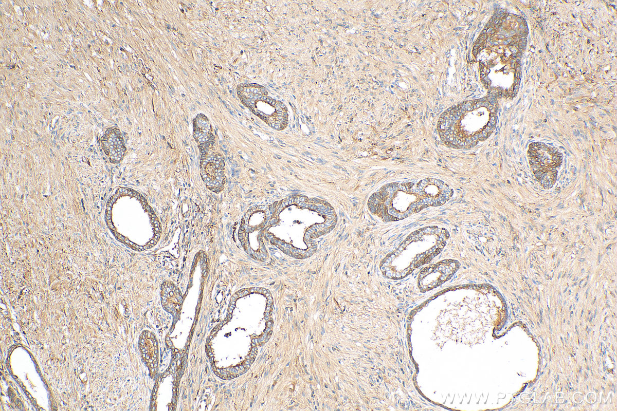 Immunohistochemistry (IHC) staining of human prostate cancer tissue using Clusterin Polyclonal antibody (30339-1-AP)