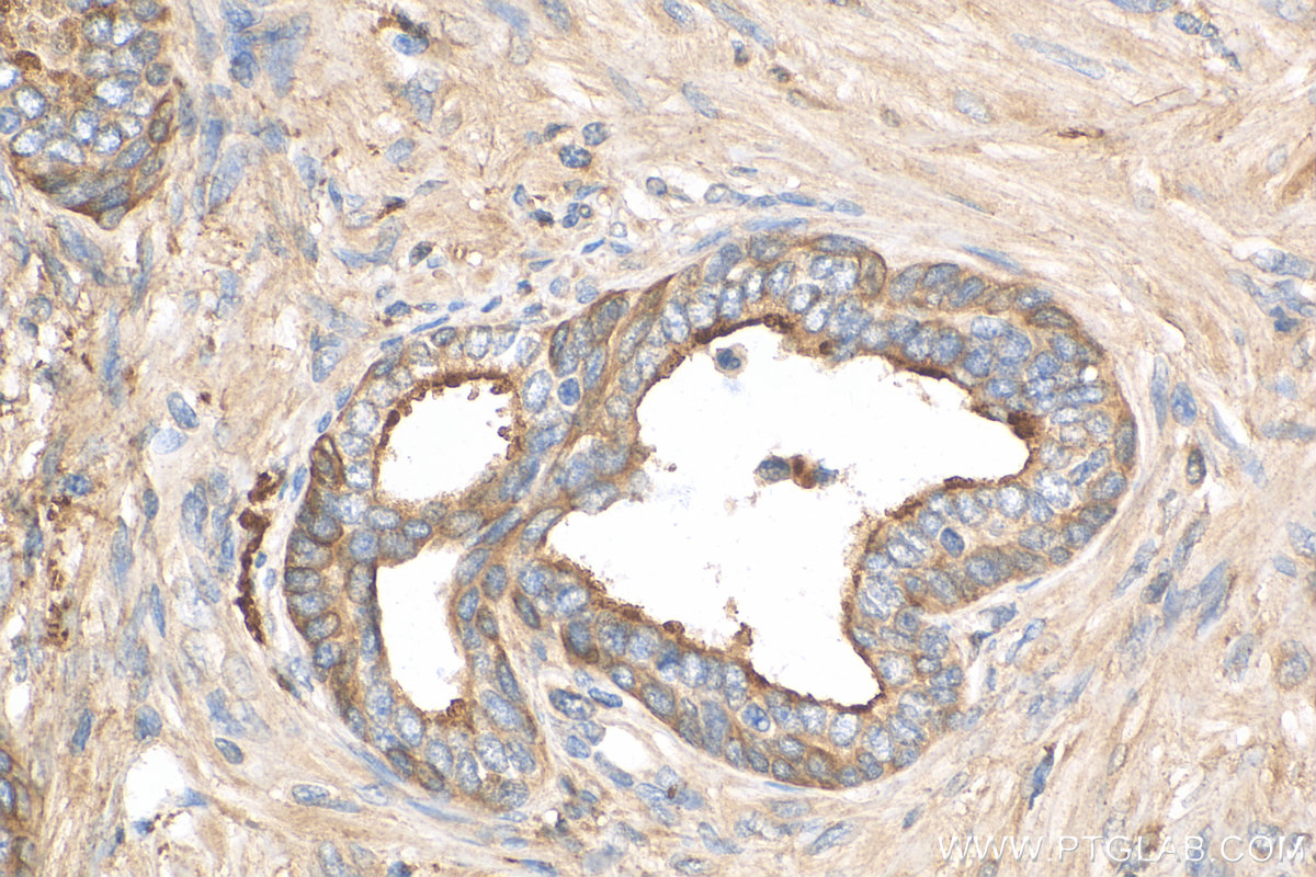 Immunohistochemistry (IHC) staining of human prostate cancer tissue using Clusterin Polyclonal antibody (30339-1-AP)