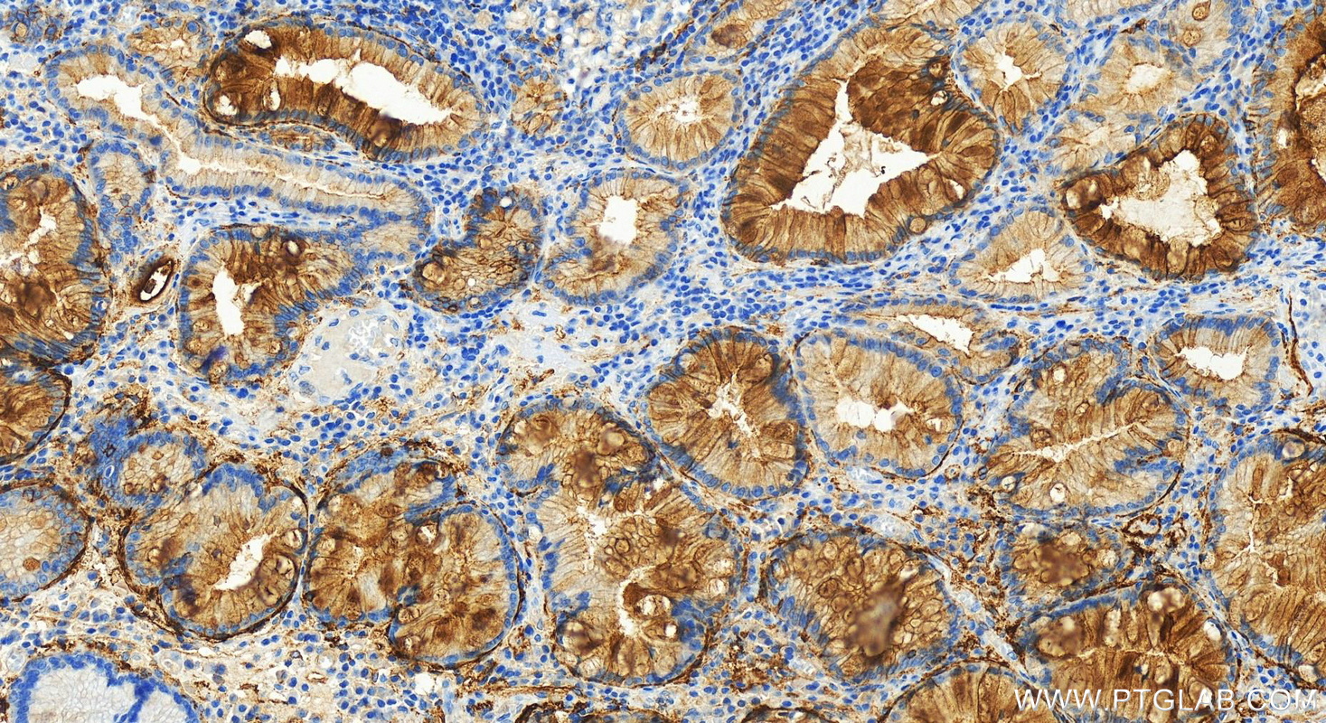 Immunohistochemistry (IHC) staining of human stomach cancer tissue using Tissue Factor Recombinant antibody (83776-4-RR)