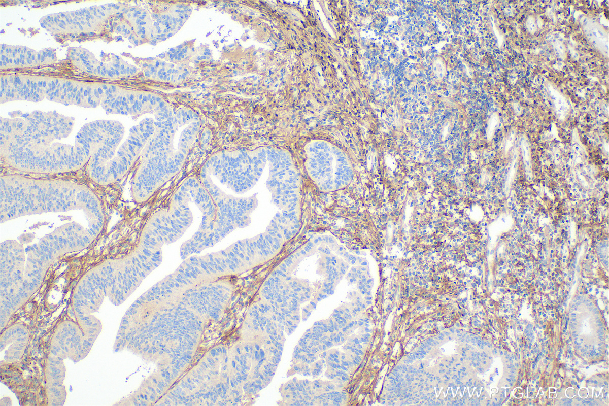 Immunohistochemistry (IHC) staining of human colon cancer tissue using Collagen Type I Monoclonal antibody (67288-1-Ig)