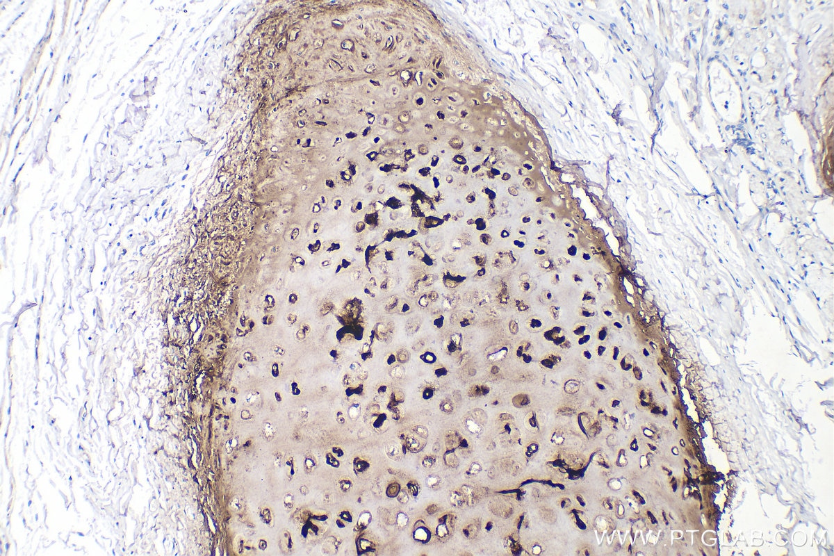 Immunohistochemistry (IHC) staining of human lung cancer tissue using Collagen Type II Polyclonal antibody (28459-1-AP)