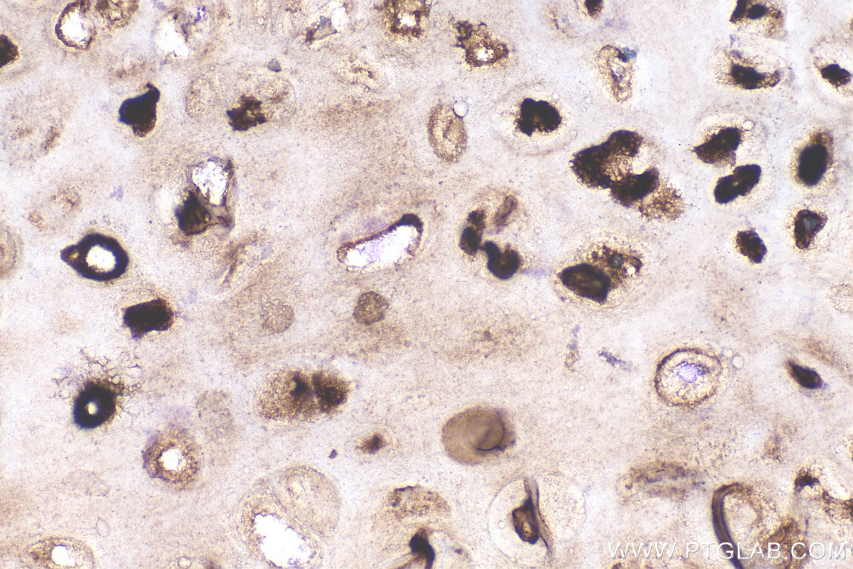 Immunohistochemistry (IHC) staining of human lung cancer tissue using Collagen Type II Polyclonal antibody (28459-1-AP)