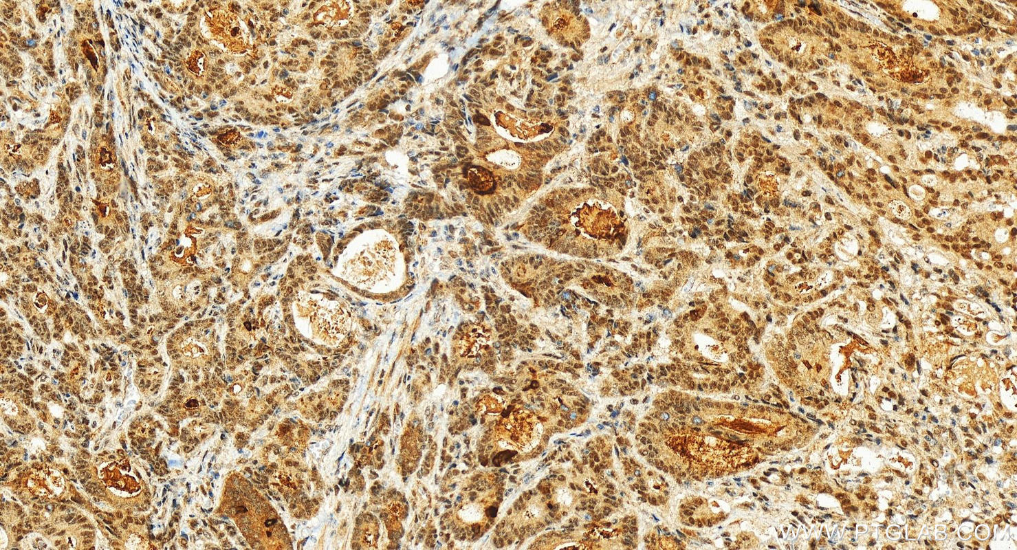 Immunohistochemistry (IHC) staining of human stomach cancer tissue using Collagen Type XXVIII Polyclonal antibody (24401-1-AP)