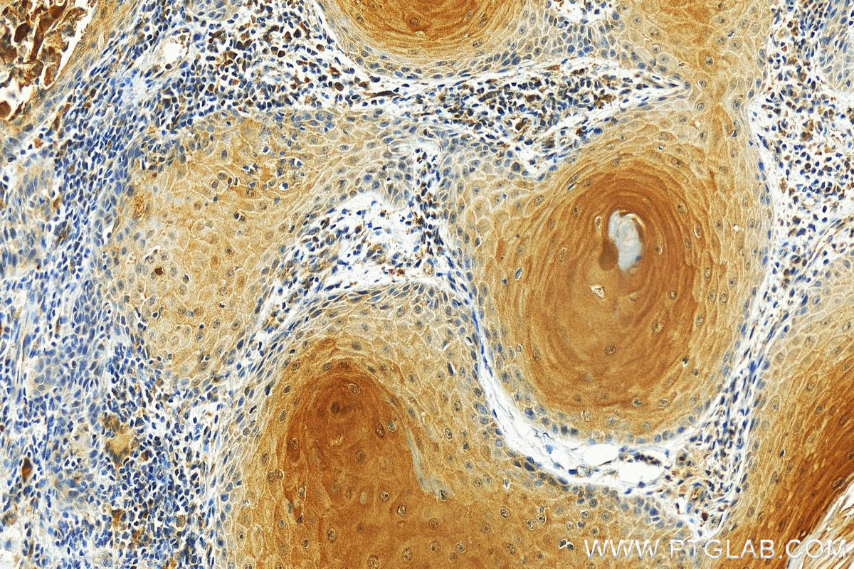 Immunohistochemistry (IHC) staining of human skin cancer tissue using Cystatin B Monoclonal antibody (66812-1-Ig)