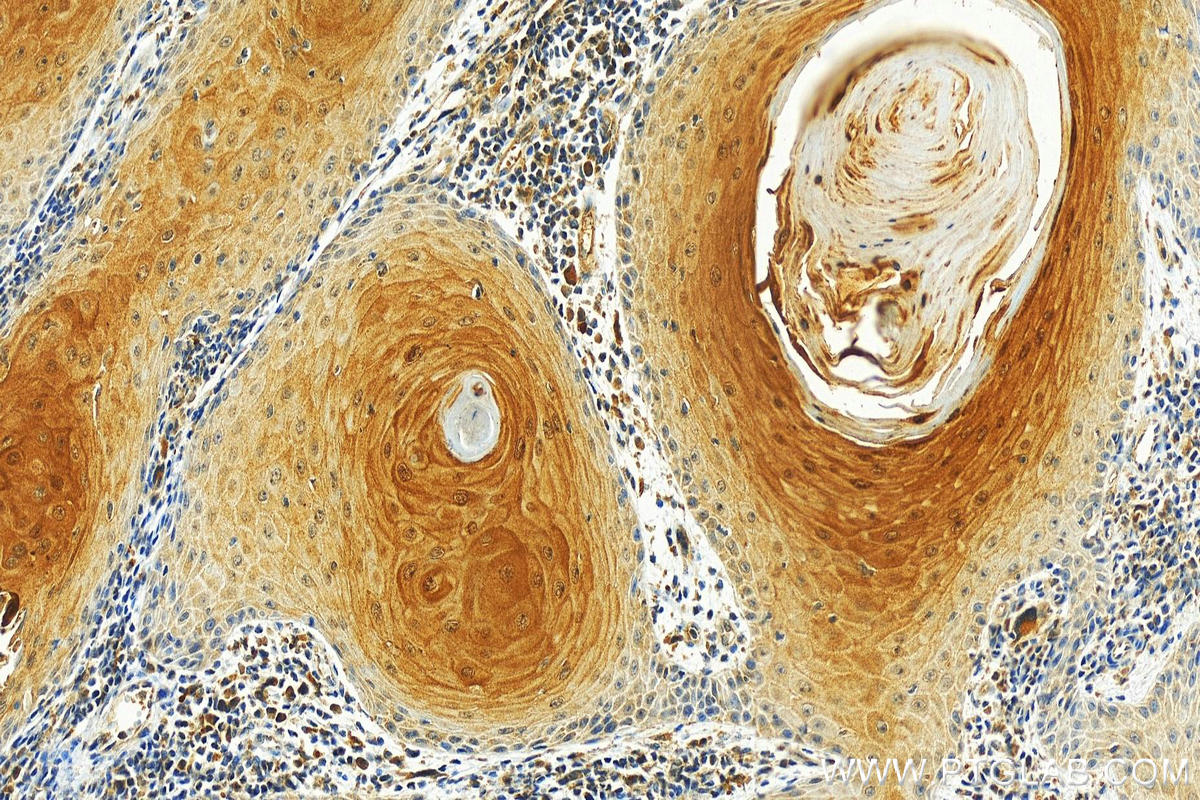 Immunohistochemistry (IHC) staining of human skin cancer tissue using Cystatin B Monoclonal antibody (66812-1-Ig)