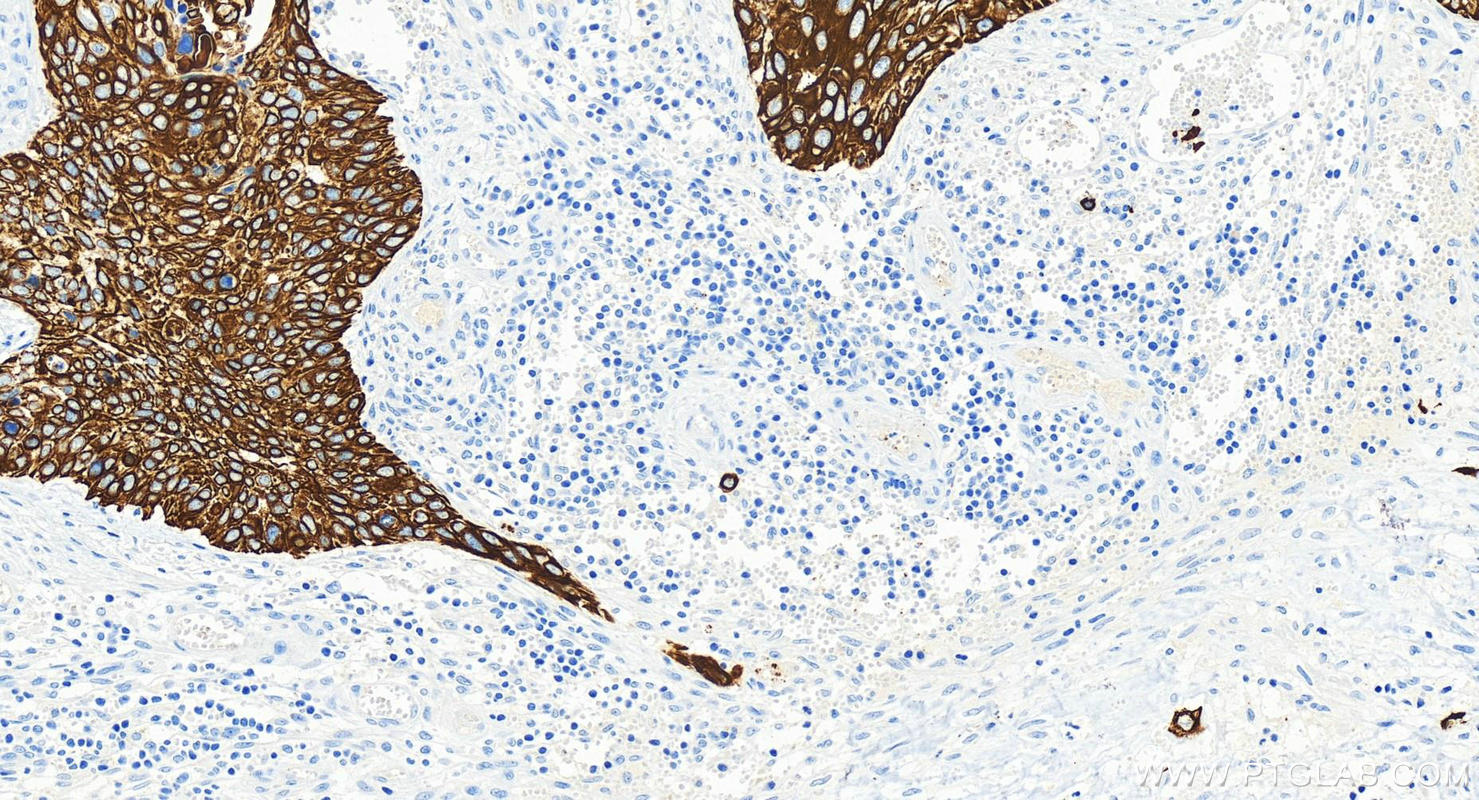 Immunohistochemistry (IHC) staining of human cervical squamous cancer tissue using Cytokeratin 13 Recombinant antibody (83058-1-RR)