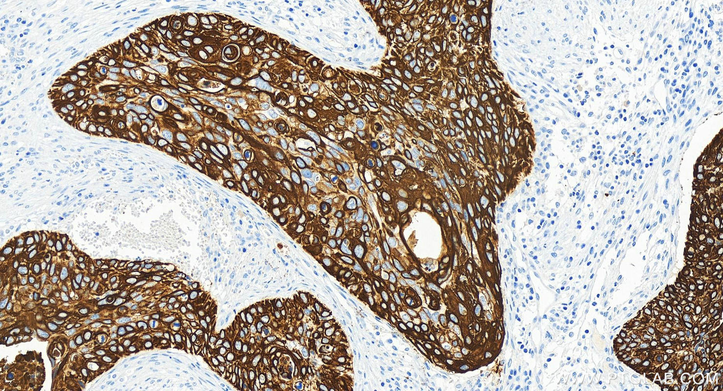 Immunohistochemistry (IHC) staining of human cervical squamous cancer tissue using Cytokeratin 13 Recombinant antibody (83058-1-RR)