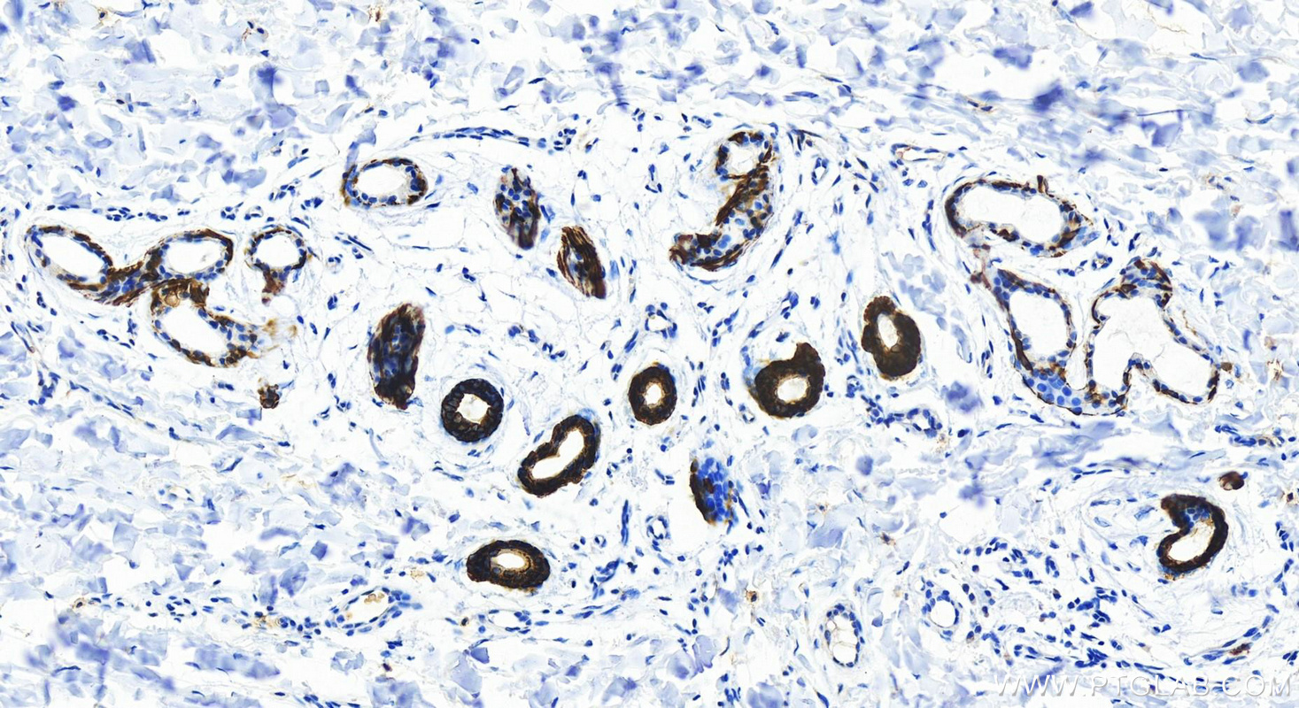 Immunohistochemistry (IHC) staining of Human bowens disease using Cytokeratin 14 Recombinant antibody (82824-1-RR)