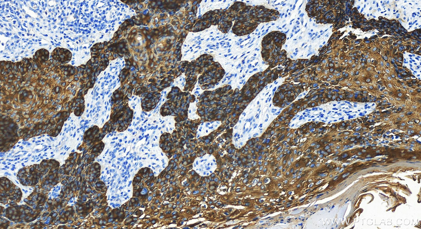 Immunohistochemistry (IHC) staining of Human bowens disease using Cytokeratin 14 Recombinant antibody (82824-1-RR)