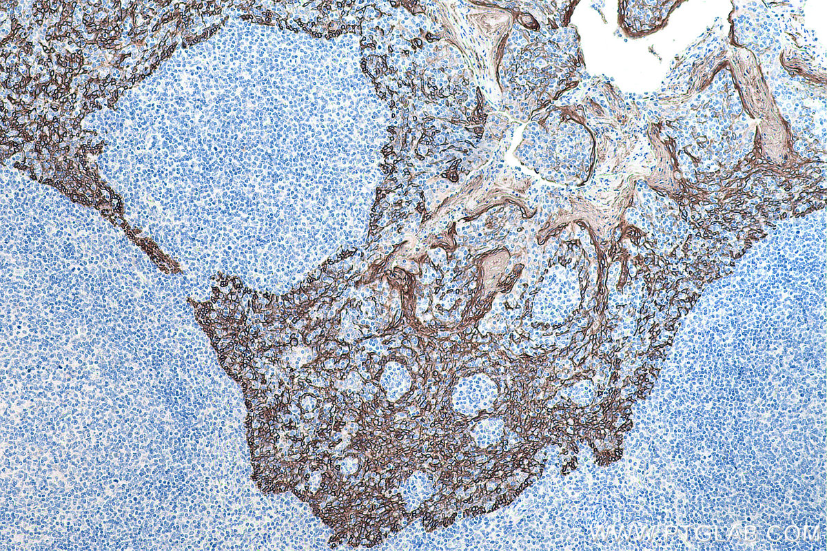 Immunohistochemistry (IHC) staining of human tonsillitis tissue using Cytokeratin 16 Monoclonal antibody (66802-1-Ig)