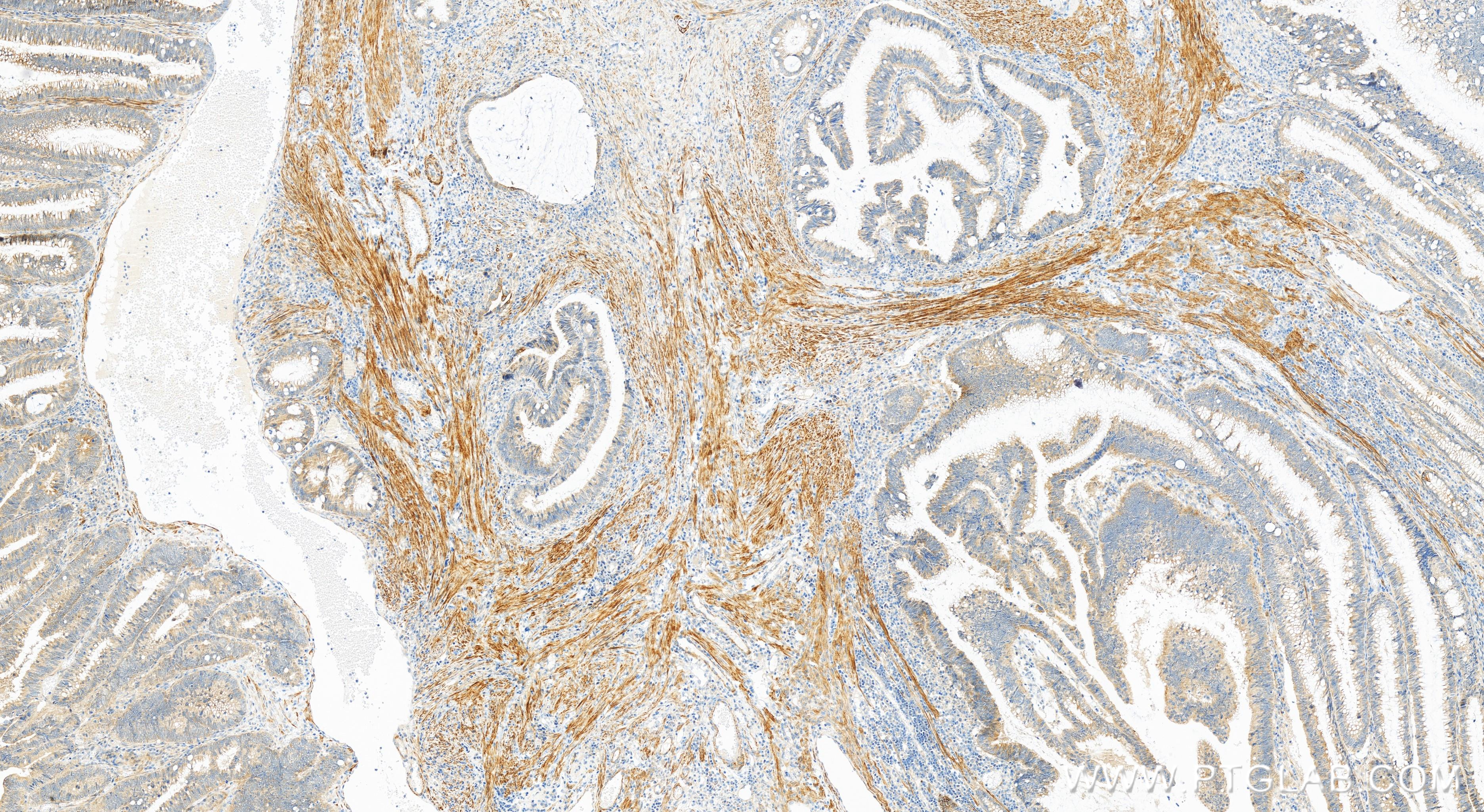 Immunohistochemistry (IHC) staining of human colon cancer tissue using Cytokeratin 17-Specific Recombinant antibody (84978-1-RR)