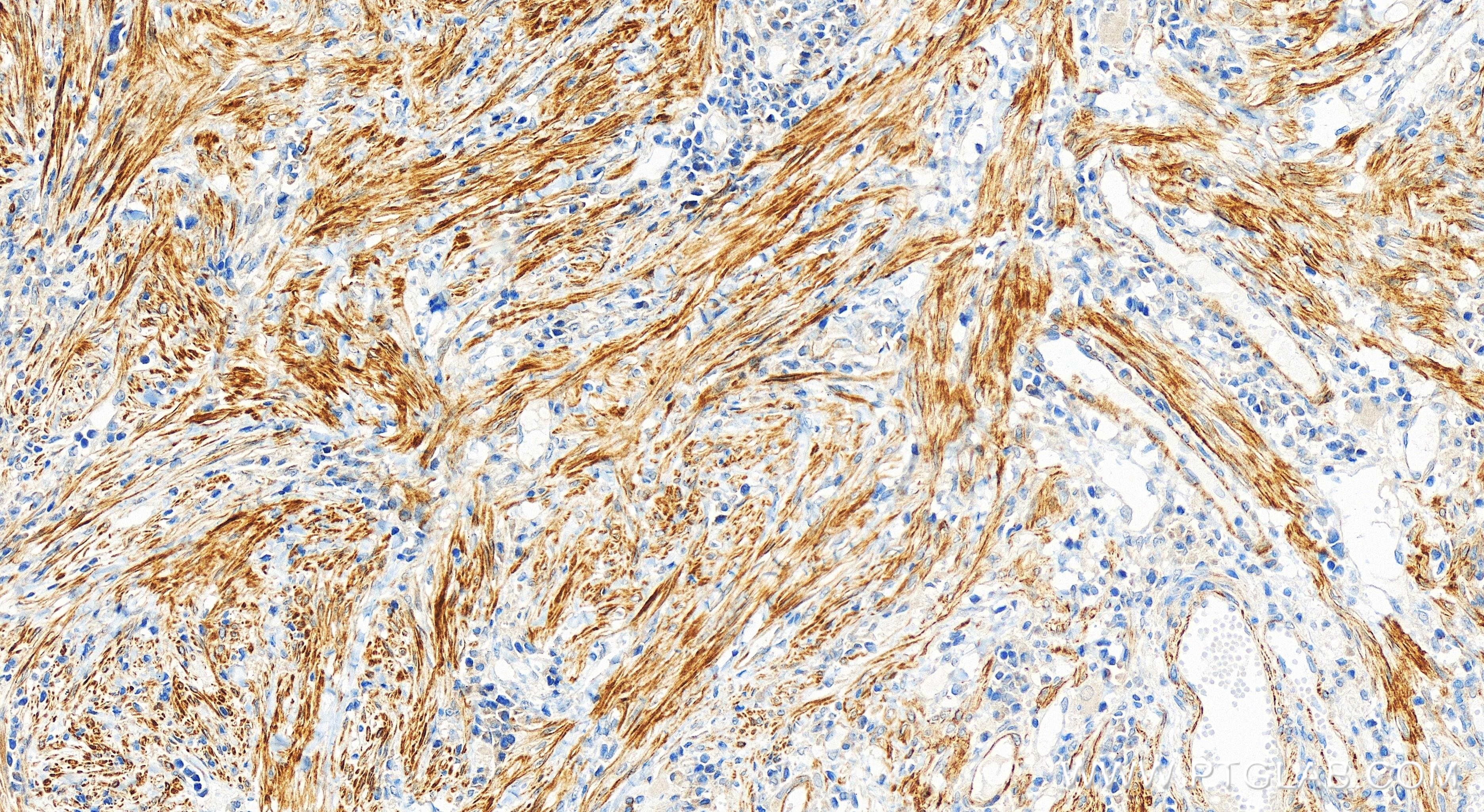 Immunohistochemistry (IHC) staining of human colon cancer tissue using Cytokeratin 17-Specific Recombinant antibody (84978-1-RR)