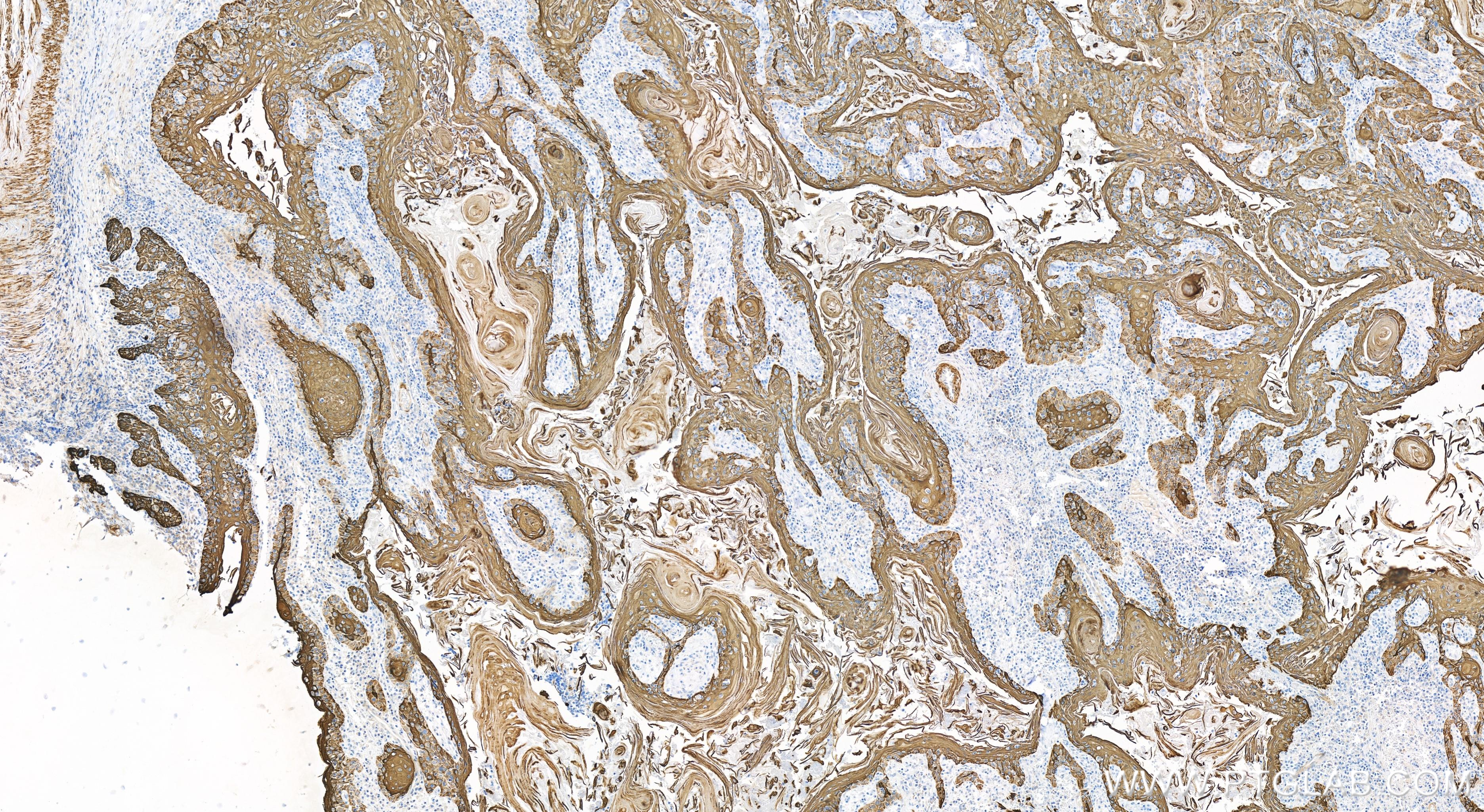 Immunohistochemistry (IHC) staining of human skin cancer tissue using Cytokeratin 17-Specific Recombinant antibody (84978-1-RR)