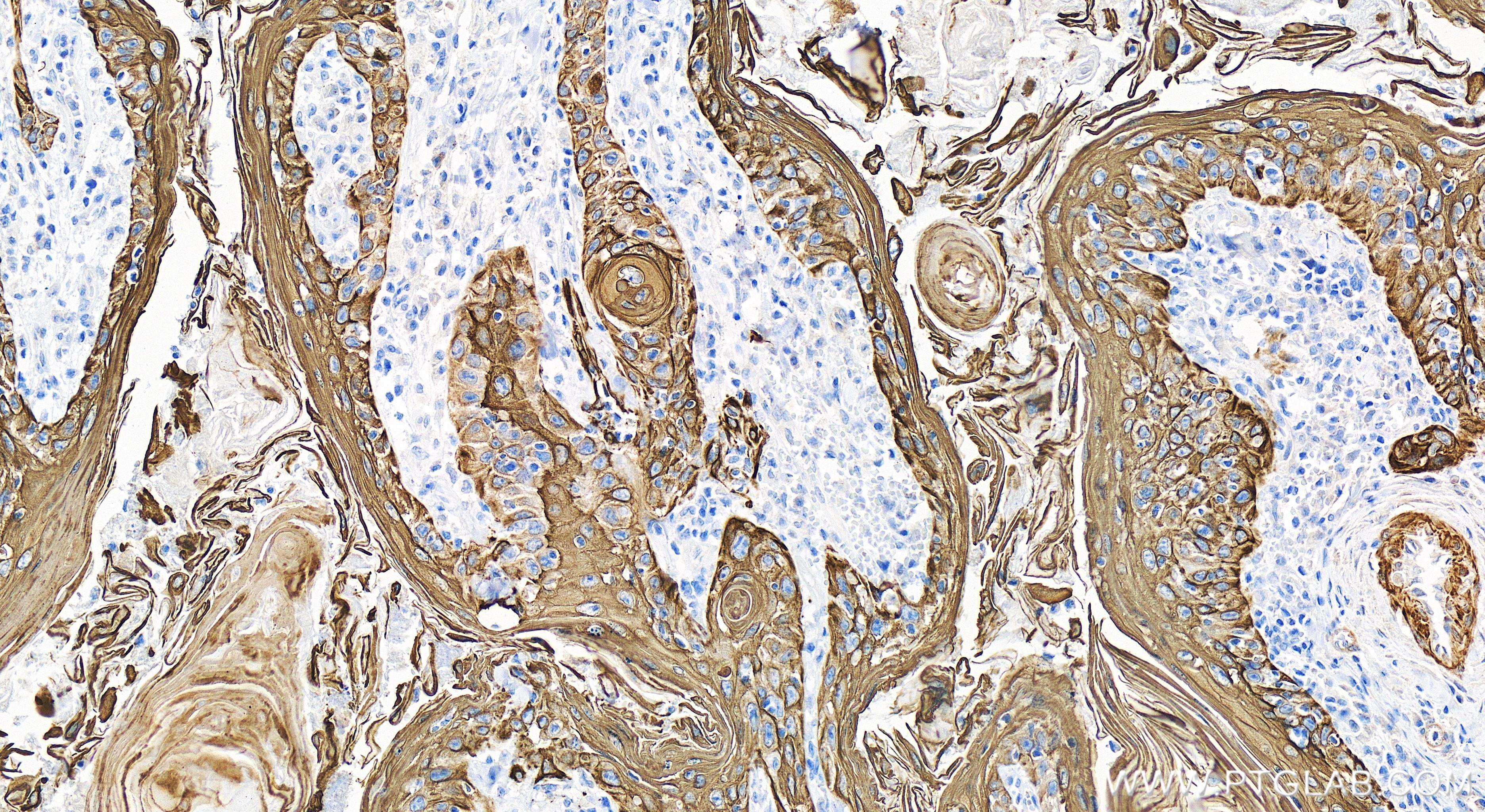 Immunohistochemistry (IHC) staining of human skin cancer tissue using Cytokeratin 17-Specific Recombinant antibody (84978-1-RR)