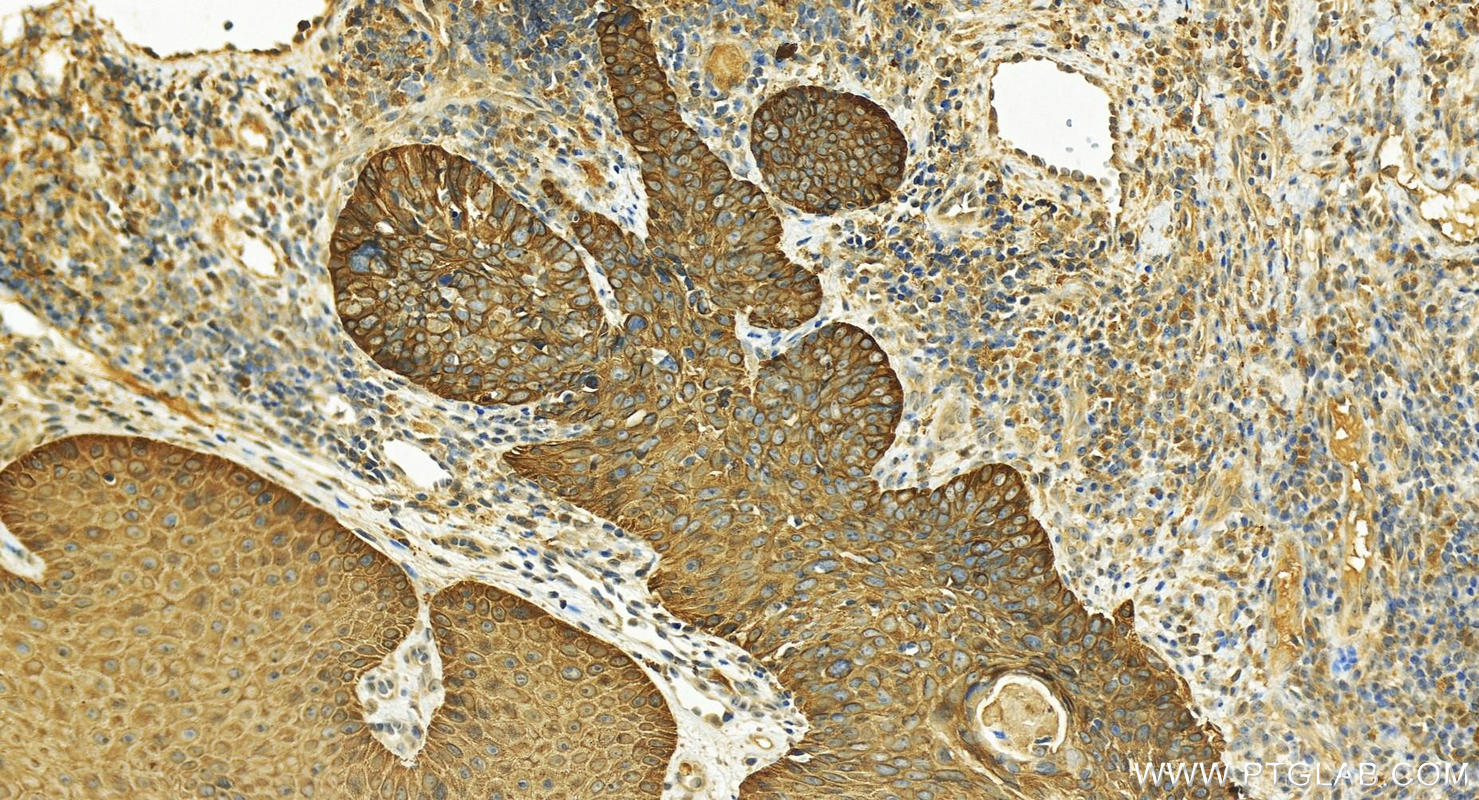 Immunohistochemistry (IHC) staining of human brown disease using Cytokeratin 5 Polyclonal antibody (28506-1-AP)