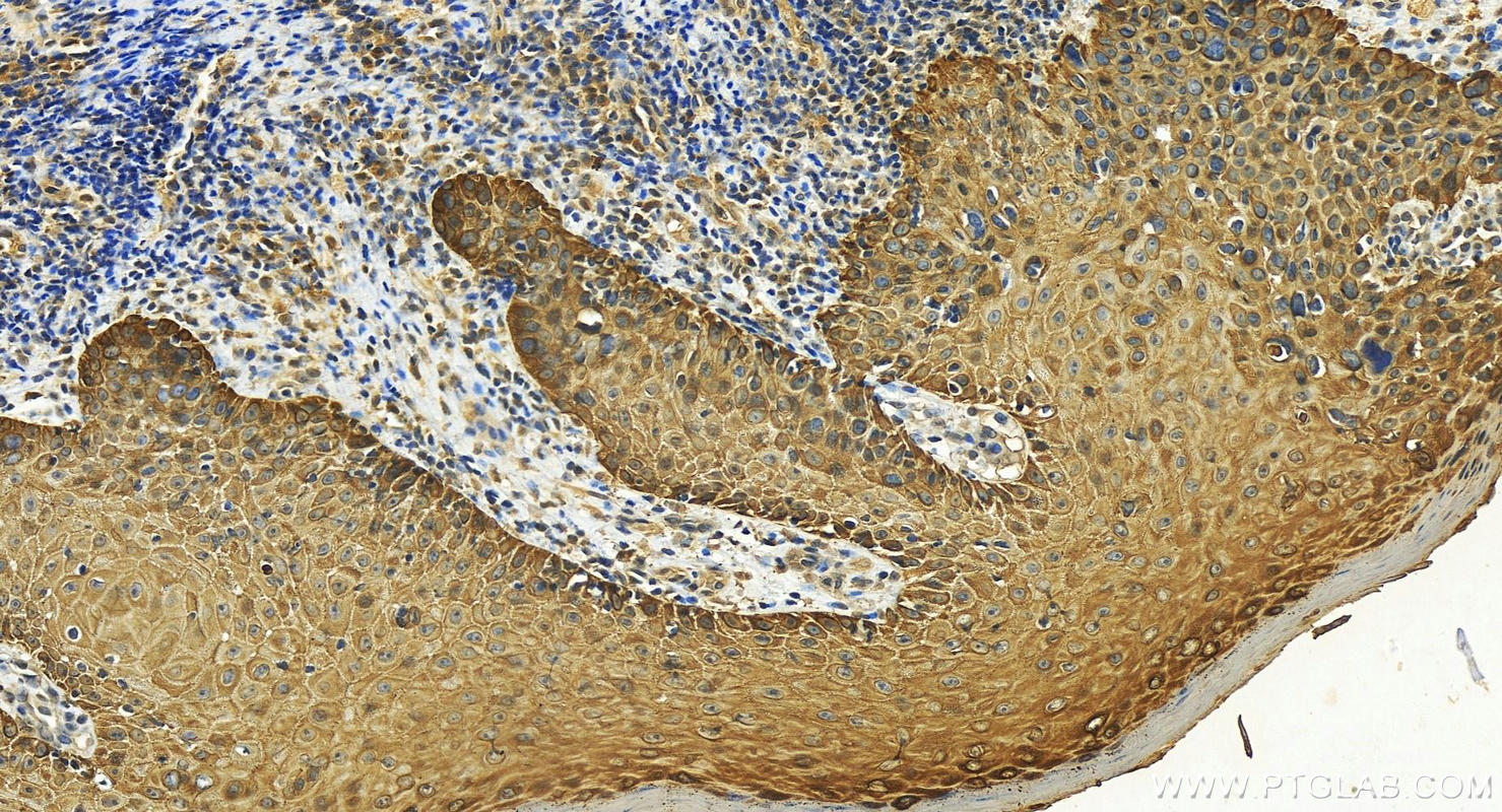 Immunohistochemistry (IHC) staining of human brown disease using Cytokeratin 5 Polyclonal antibody (28506-1-AP)