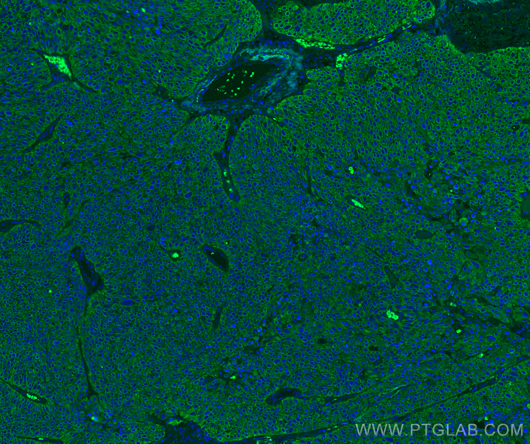 Immunofluorescence (IF) / fluorescent staining of human lung cancer tissue using Cytokeratin 5 Monoclonal antibody (66727-1-Ig)