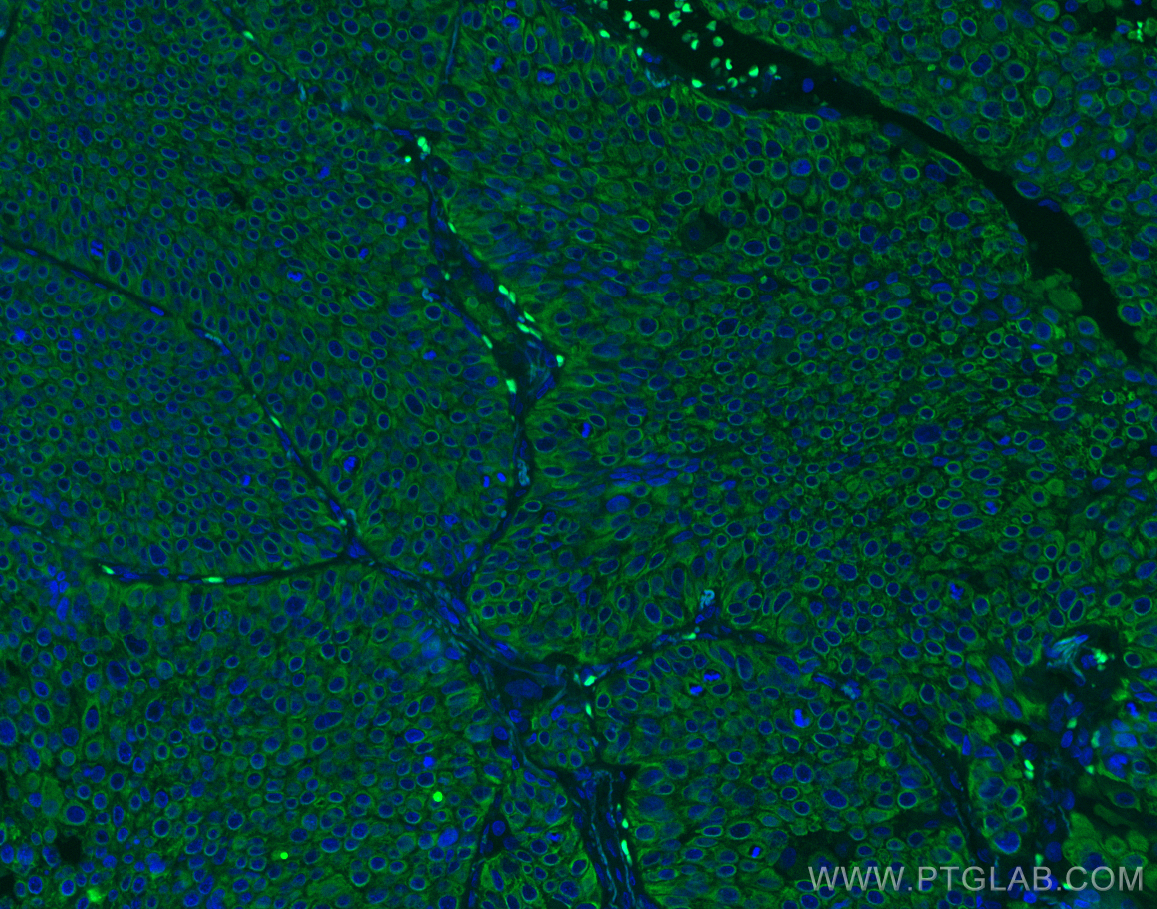 Immunofluorescence (IF) / fluorescent staining of human lung cancer tissue using Cytokeratin 5 Monoclonal antibody (66727-1-Ig)