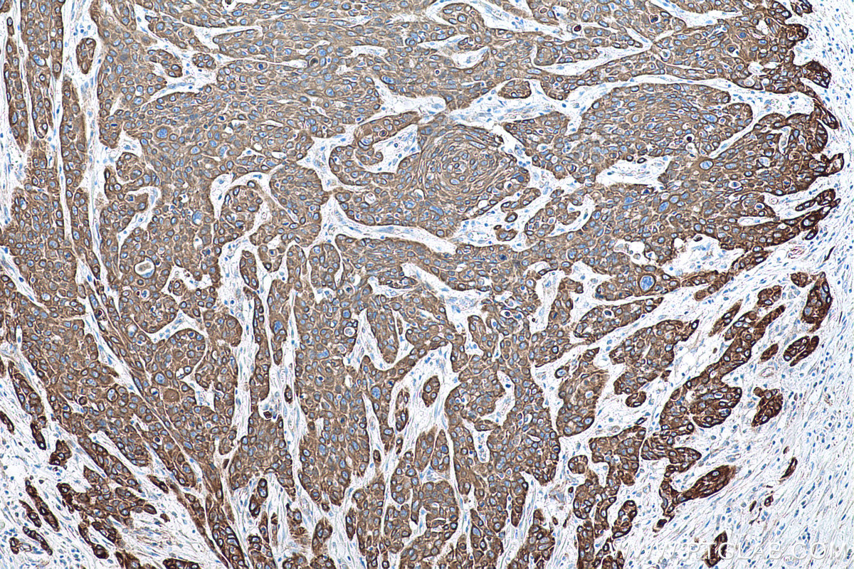 Immunohistochemistry (IHC) staining of human oesophagus cancer tissue using Cytokeratin 5 Monoclonal antibody (66727-1-Ig)