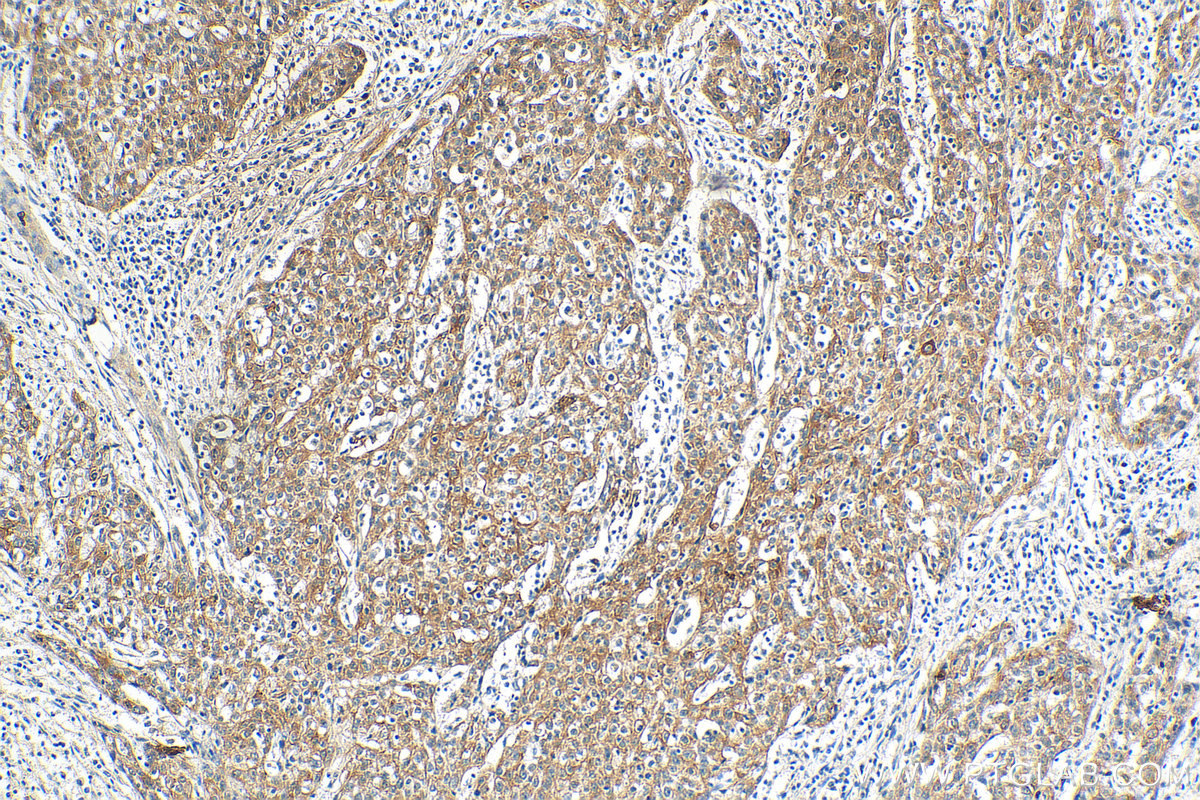 Immunohistochemistry (IHC) staining of human cervical cancer tissue using Cytokeratin 6A Monoclonal antibody (66685-1-Ig)