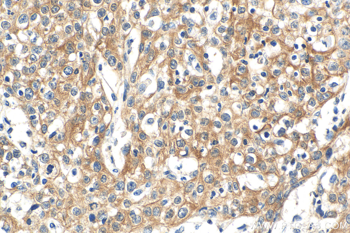 Immunohistochemistry (IHC) staining of human cervical cancer tissue using Cytokeratin 6A Monoclonal antibody (66685-1-Ig)