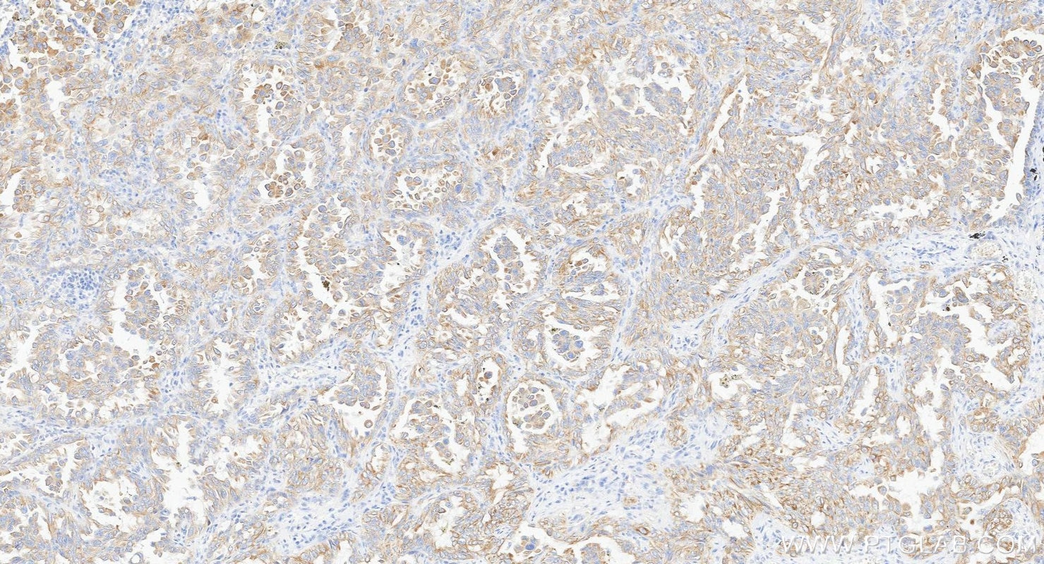 Immunohistochemistry (IHC) staining of human lung cancer tissue using Biotin-conjugated Cytokeratin 7 Monoclonal antibod (Biotin-66483)