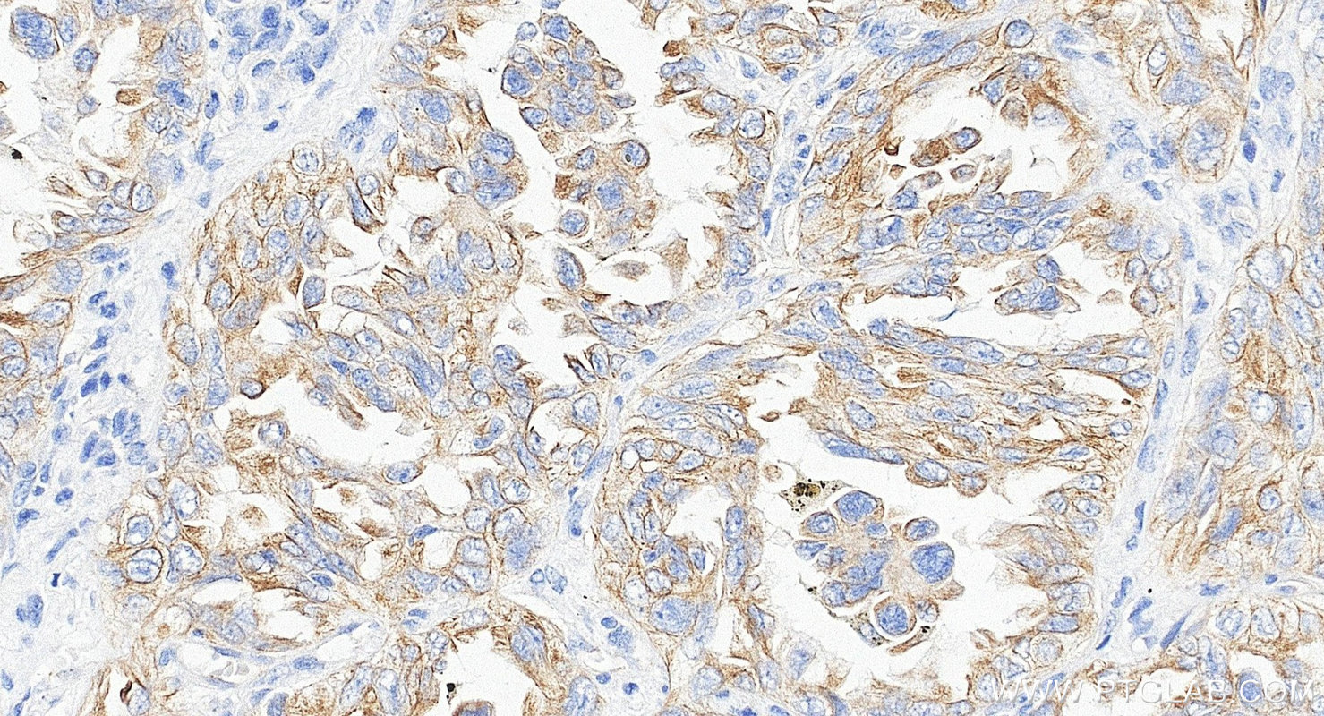 Immunohistochemistry (IHC) staining of human lung cancer tissue using Biotin-conjugated Cytokeratin 7 Monoclonal antibod (Biotin-66483)