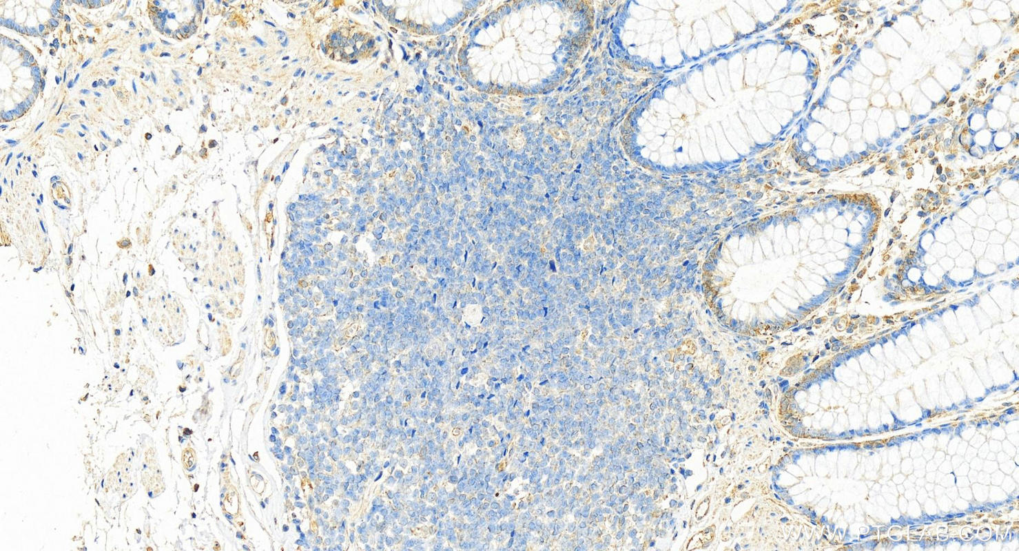 Immunohistochemistry (IHC) staining of human colon tissue using Cytokeratin 8 Monoclonal antibody (68627-1-Ig)