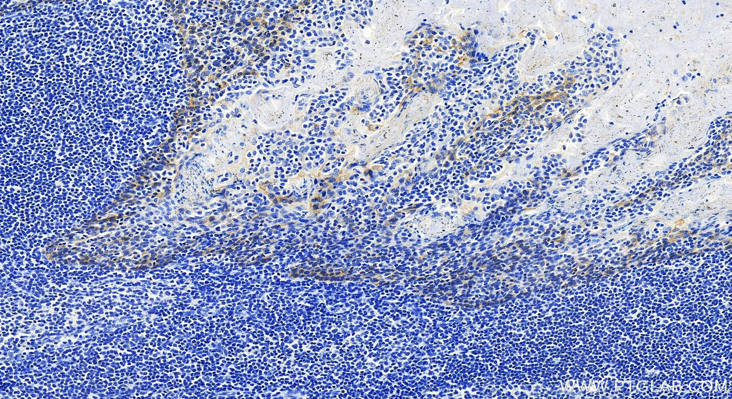 Immunohistochemistry (IHC) staining of human tonsillitis tissue using Cytokeratin 8 Monoclonal antibody (68627-1-Ig)