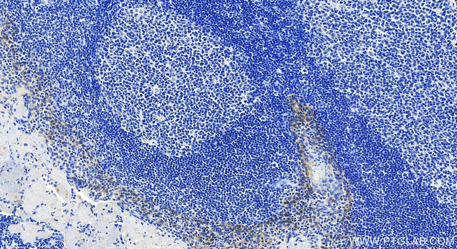 Immunohistochemistry (IHC) staining of human tonsillitis tissue using Cytokeratin 8 Monoclonal antibody (68627-1-Ig)