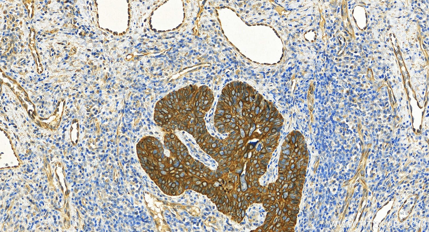 Immunohistochemistry (IHC) staining of human brown disease using Cytokeratin 8-specific Polyclonal antibody (27105-1-AP)