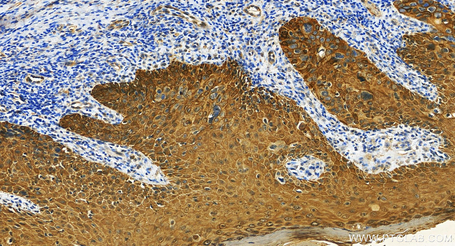 Immunohistochemistry (IHC) staining of human brown disease using Cytokeratin 8-specific Polyclonal antibody (27105-1-AP)