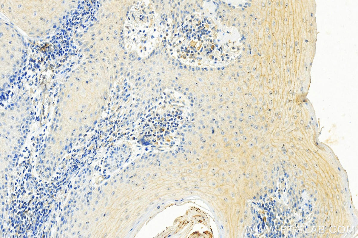 Immunohistochemistry (IHC) staining of human skin cancer tissue using DAAM1 Monoclonal antibody (67287-1-Ig)