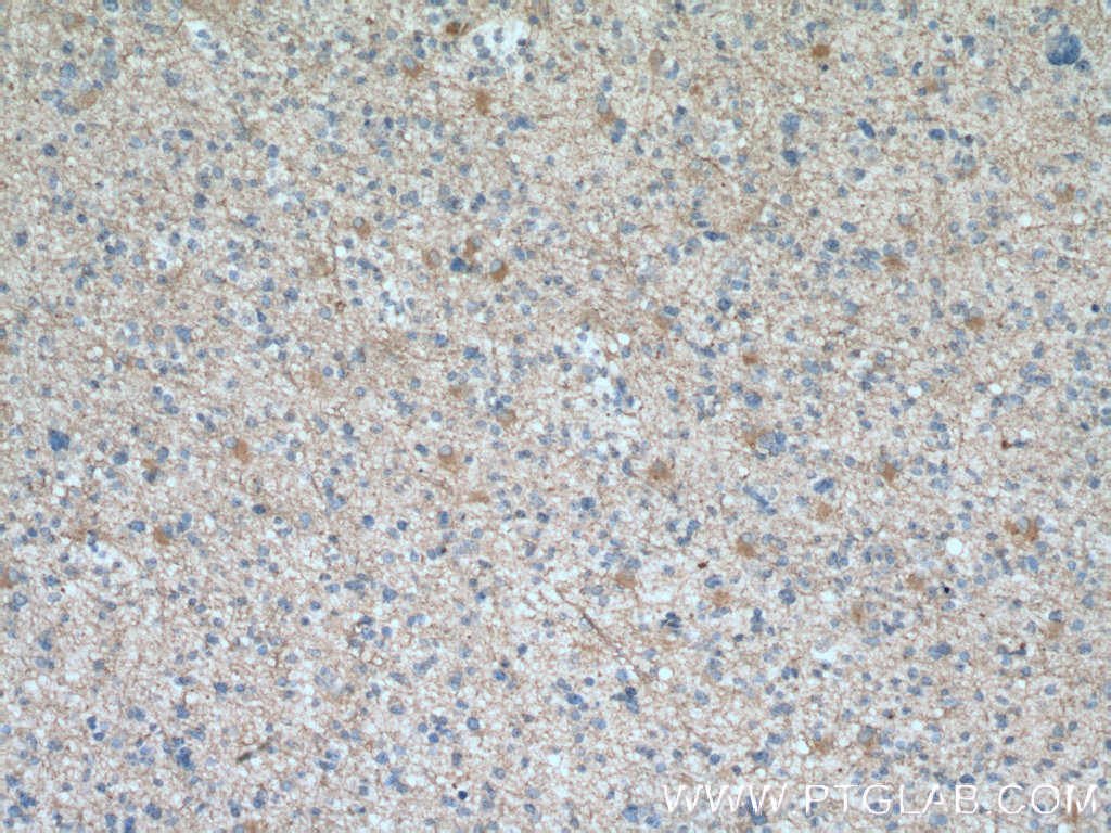 Immunohistochemistry (IHC) staining of human gliomas tissue using DAO Monoclonal antibody (66296-1-Ig)