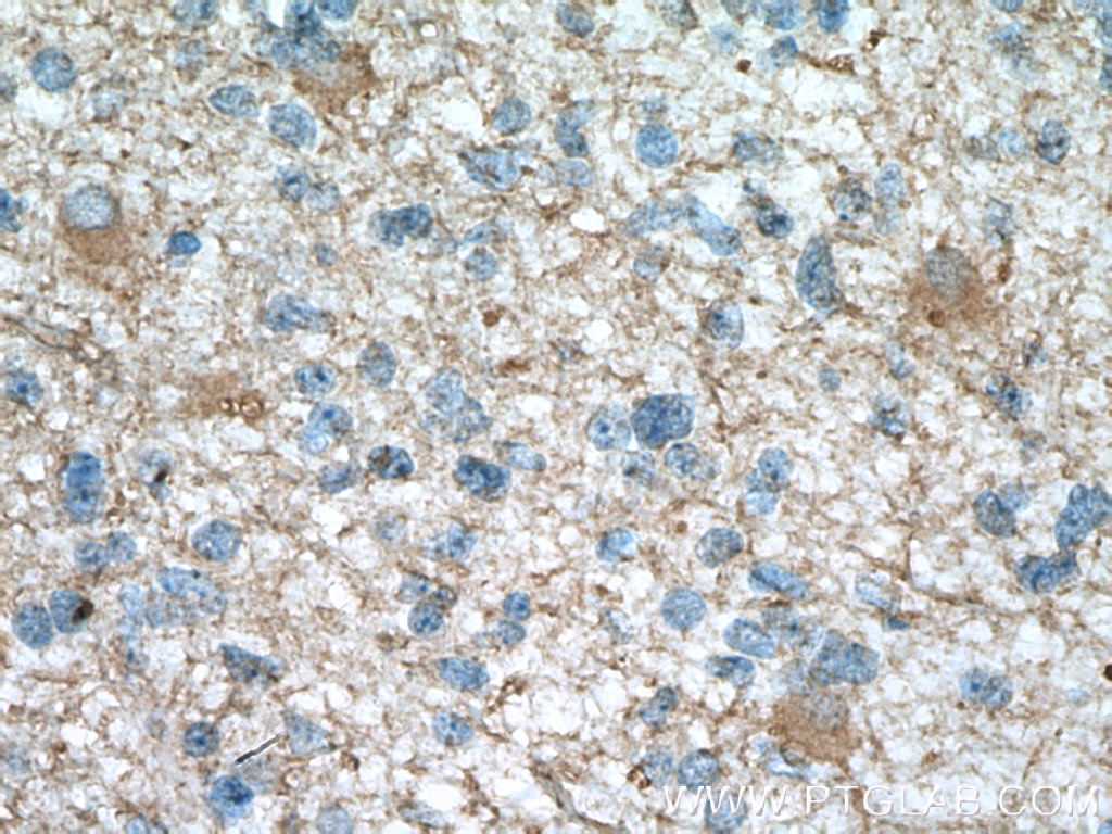 Immunohistochemistry (IHC) staining of human gliomas tissue using DAO Monoclonal antibody (66296-1-Ig)