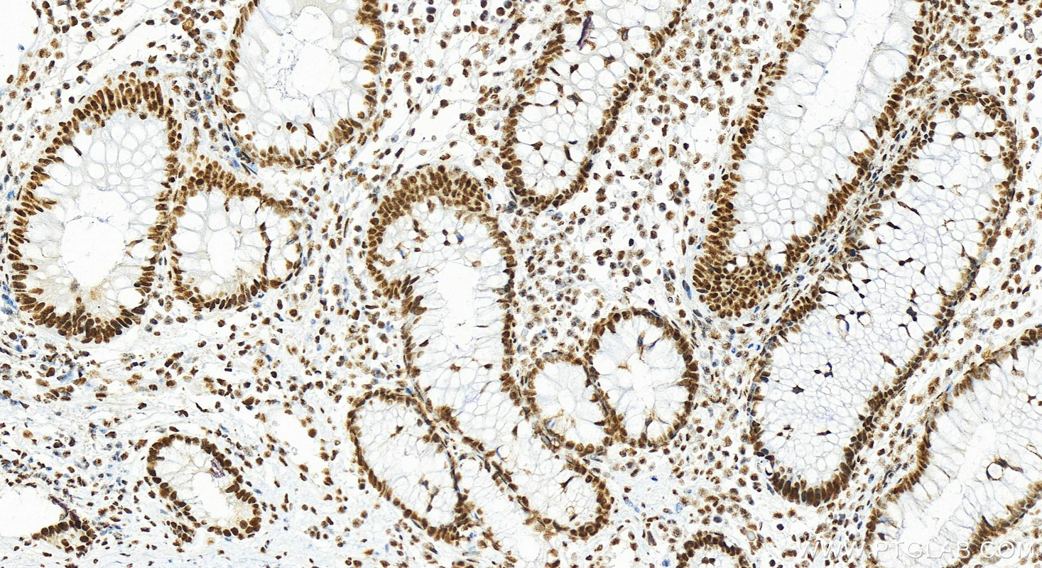 Immunohistochemistry (IHC) staining of human colon cancer tissue using CCAR2 Polyclonal antibody (22638-1-AP)