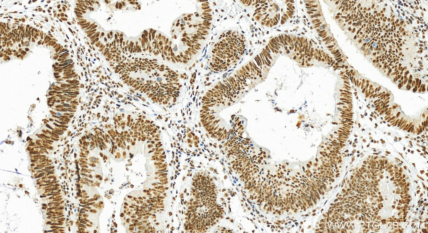 Immunohistochemistry (IHC) staining of human colon cancer tissue using CCAR2 Polyclonal antibody (22638-1-AP)