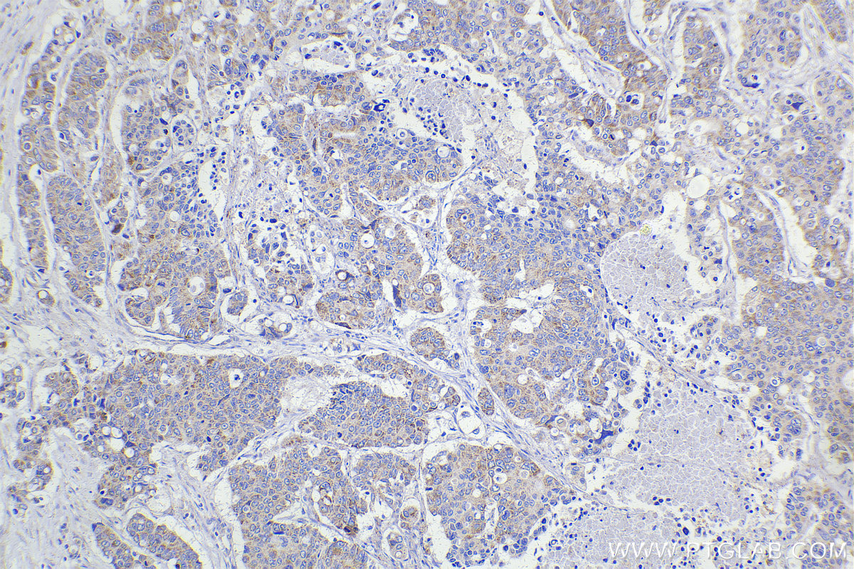 Immunohistochemistry (IHC) staining of human stomach cancer tissue using DBT Polyclonal antibody (12451-1-AP)