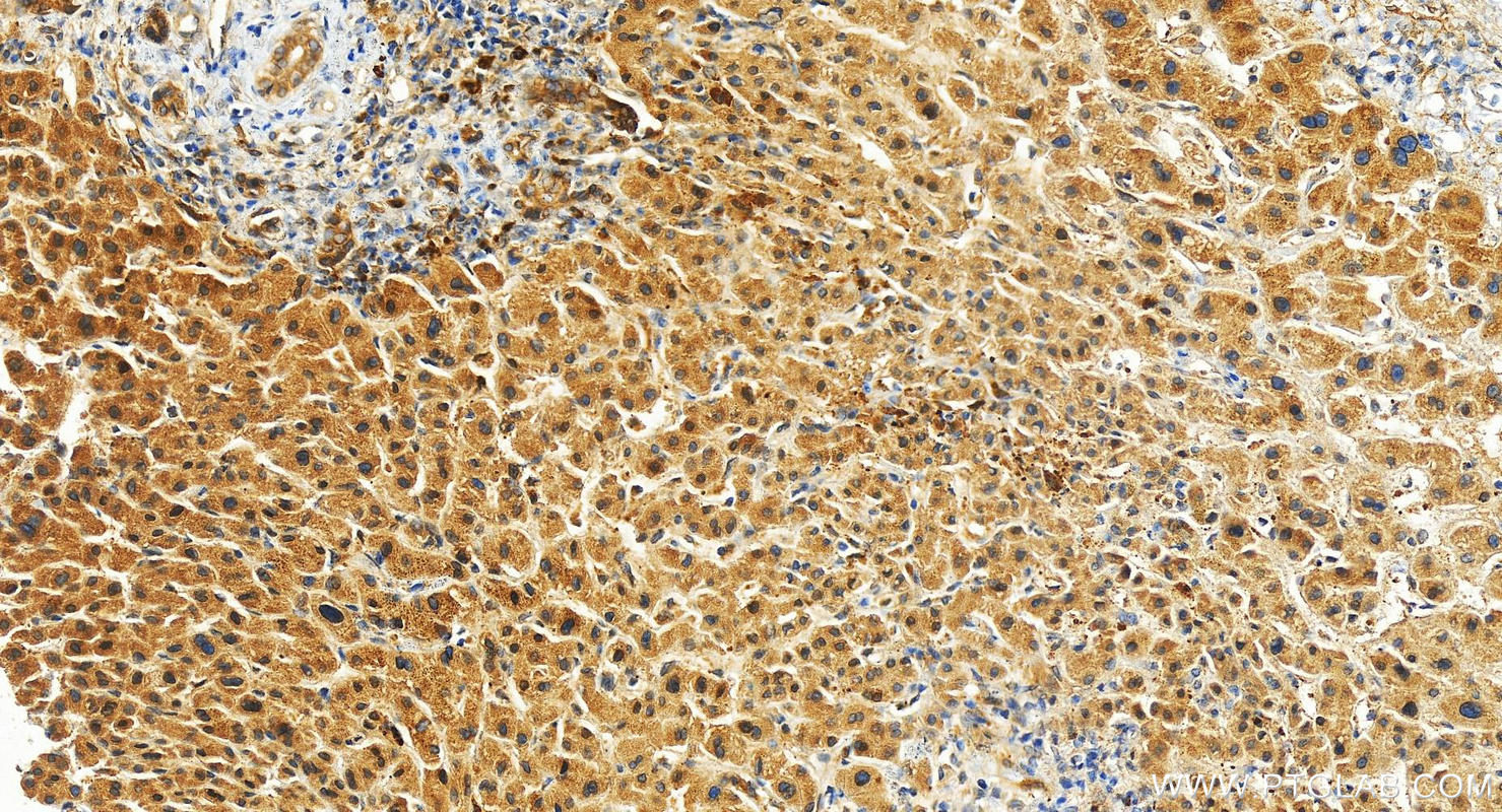 Immunohistochemistry (IHC) staining of human intrahepatic cholangiocarcinoma tissue using DCBLD2 Polyclonal antibody (13168-1-AP)