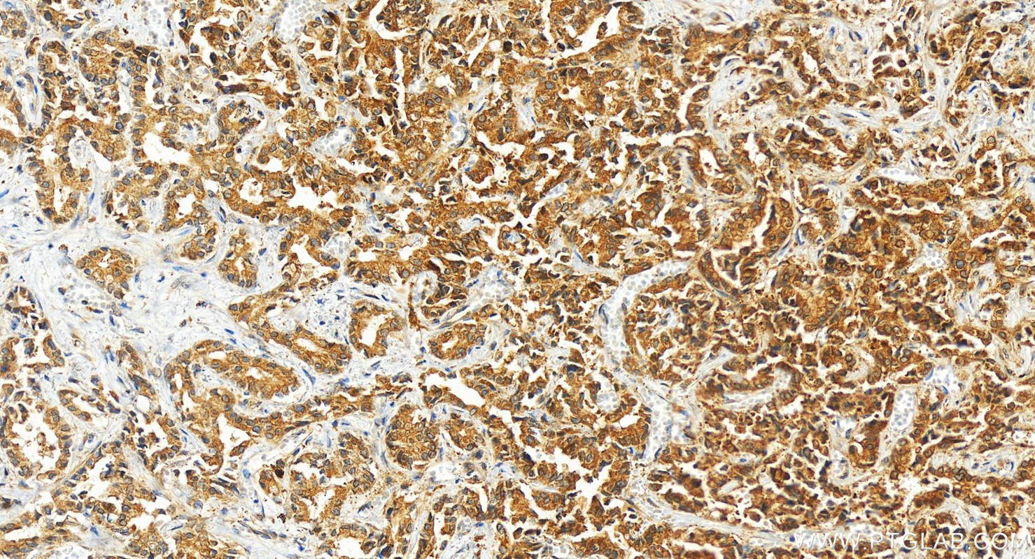 Immunohistochemistry (IHC) staining of human intrahepatic cholangiocarcinoma tissue using DCBLD2 Polyclonal antibody (13168-1-AP)