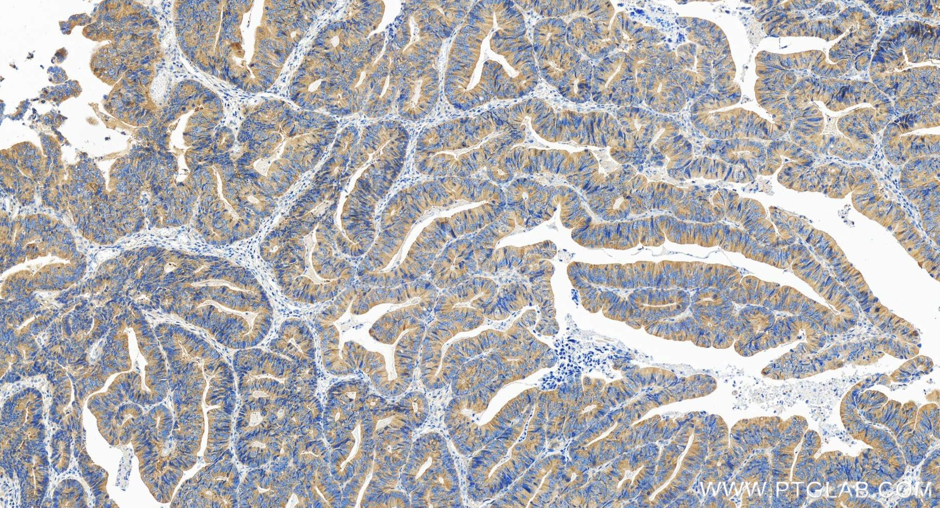 Immunohistochemistry (IHC) staining of human colon cancer tissue using DCP1A Recombinant antibody (85047-5-RR)