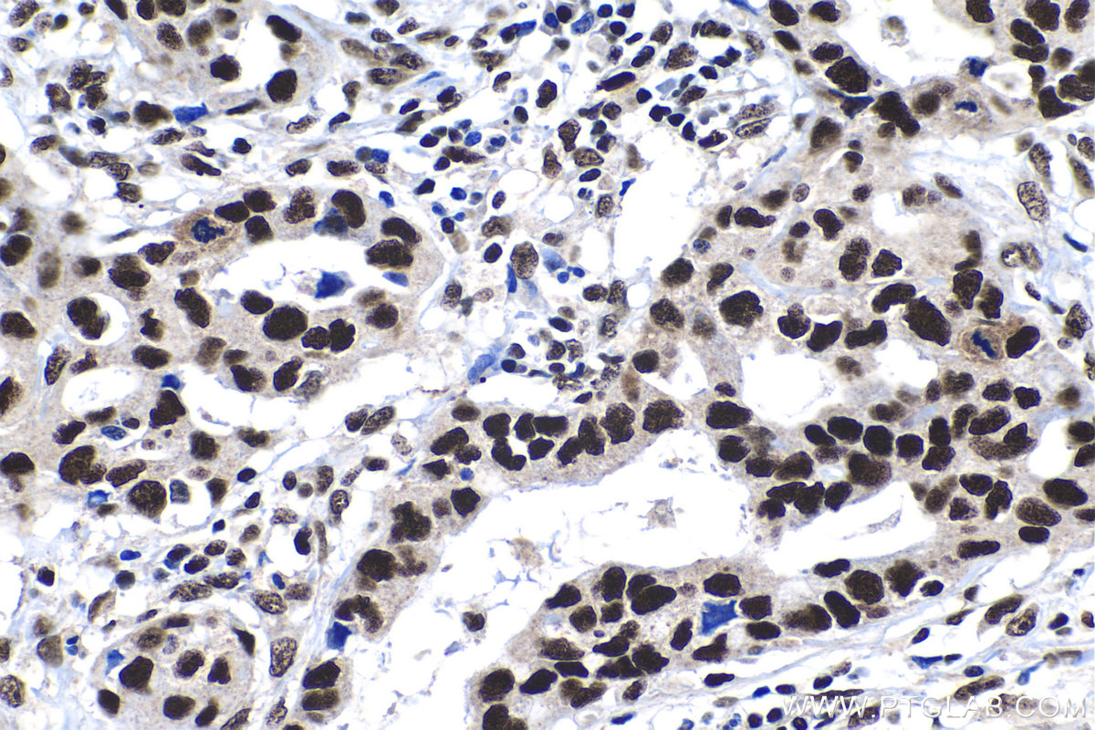 Immunohistochemistry (IHC) staining of human lung cancer tissue using DDA1 Polyclonal antibody (14995-1-AP)